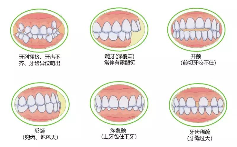 牙齿不齐有什么影响