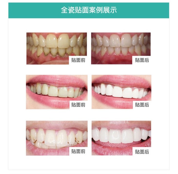 全瓷贴面可以用于牙齿的美白